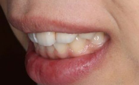 20代女性の入れ歯治療〜素敵な笑顔を取り戻す方法〜