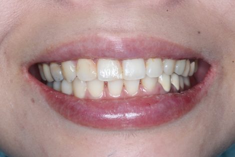 ブリッジから入れ歯へ〜下あご奥歯3本、インプラント以外の治療方法〜