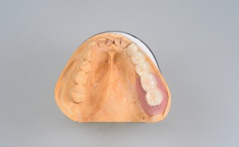 目立たない奥歯の入れ歯、リーゲルテレスコープ