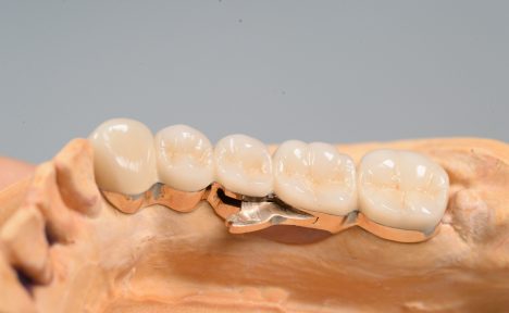 奥歯の入れ歯、リーゲルテレスコープ
