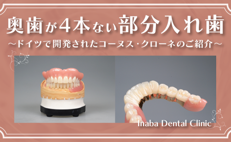 奥歯が4本ない場合の部分入れ歯について〜ドイツで開発されたコーヌス・クローネのご紹介〜
