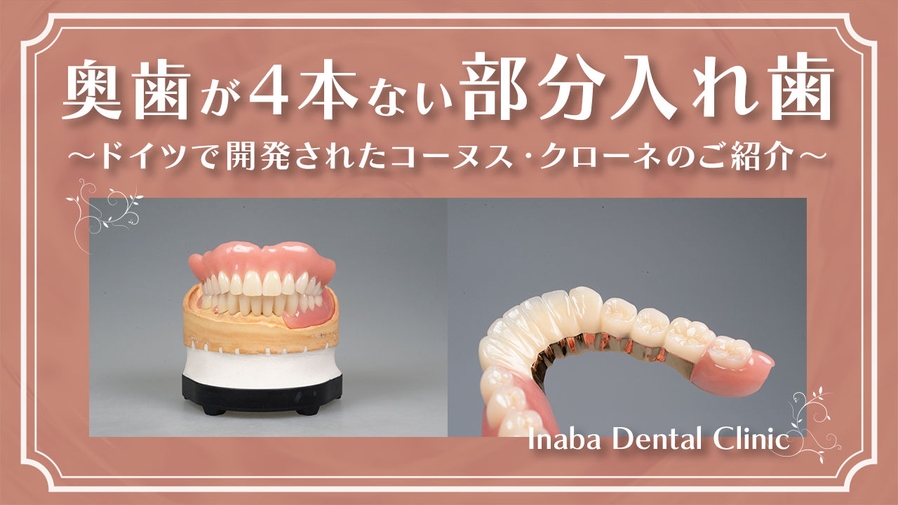 奥歯が4本ない場合の部分入れ歯について〜ドイツで開発されたコーヌス・クローネのご紹介〜